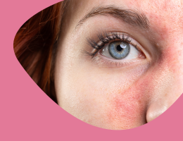 Dermatite atopique : les idées claires