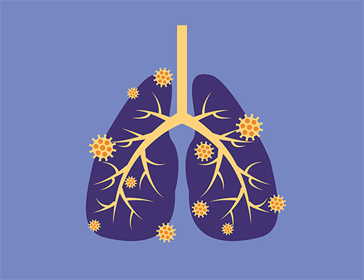 Les nouveaux enjeux de l'asthme sévère-1