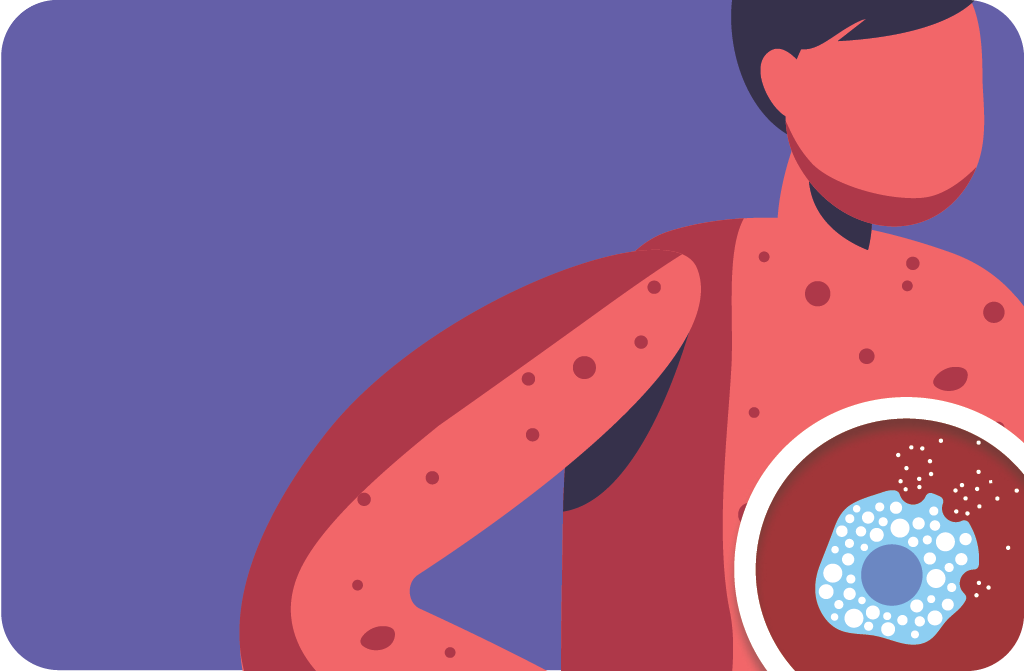 Ne passons plus à côté d'une mastocytose systémique : quand y penser, quand l'adresser ?
