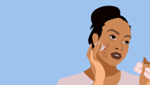 Acné et contraception orale : quelle conduite à tenir en pratique en ville ?