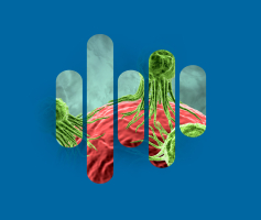 Prise en charge du cancer de la prostate au défi croissant de la qualité de vie