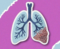 Fibrose pulmonaire : y penser, c’est déjà agir